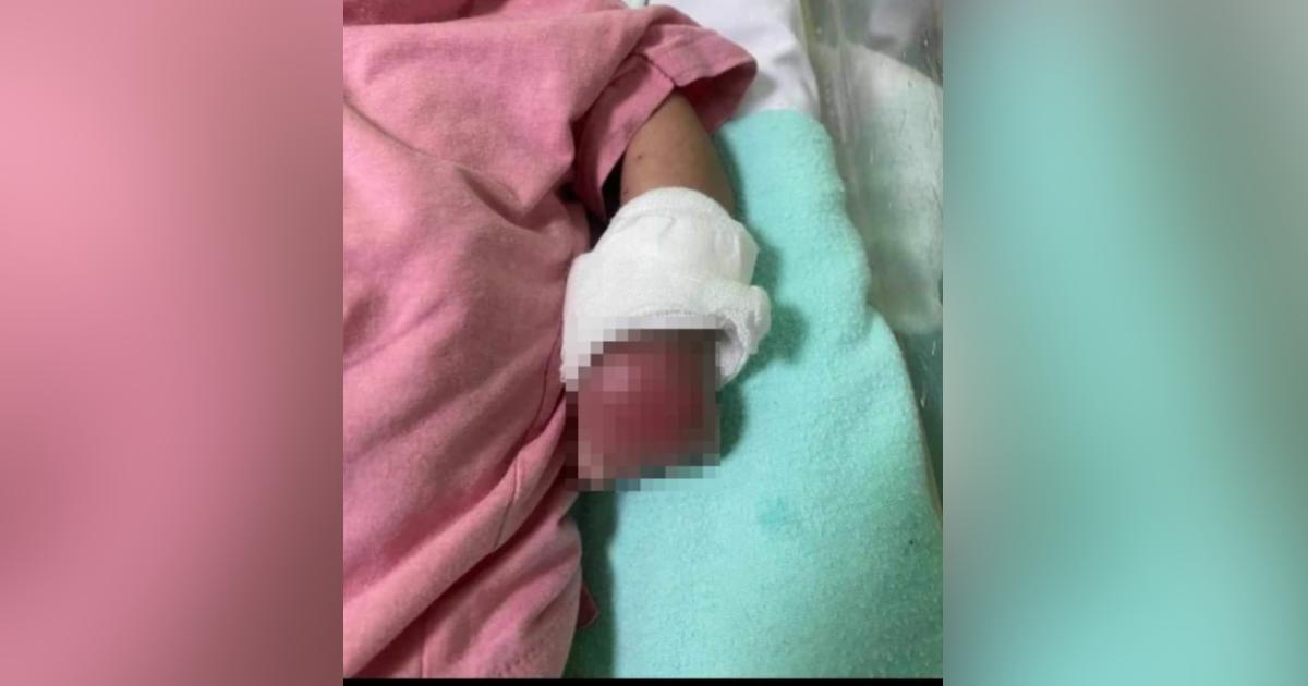 Hospital Melaka siasat dakwaan tangan bayi bengkak dan bernanah